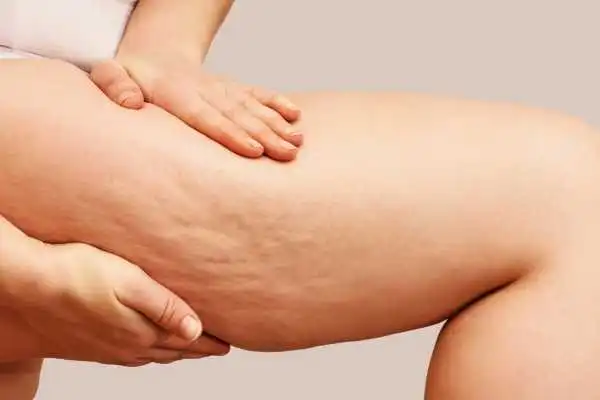Image of woman showing leg with cellulite Newcastle under Lyme