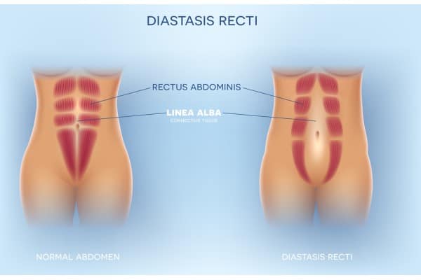 How Does Non-Surgical Treatment Help With Loose Skin, Weak Abdominal Muscles and Post-Pregnancy Changes Newcastle under Lyme?