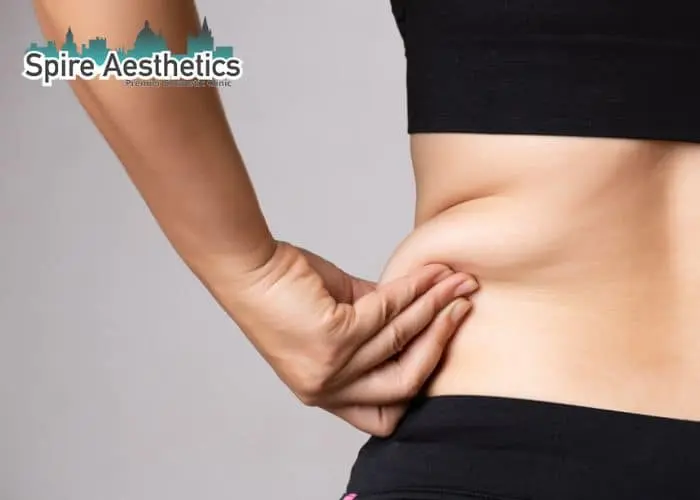 Image of woman pinching fat on their hips Newcastle under Lyme. Fat Freezing treatment