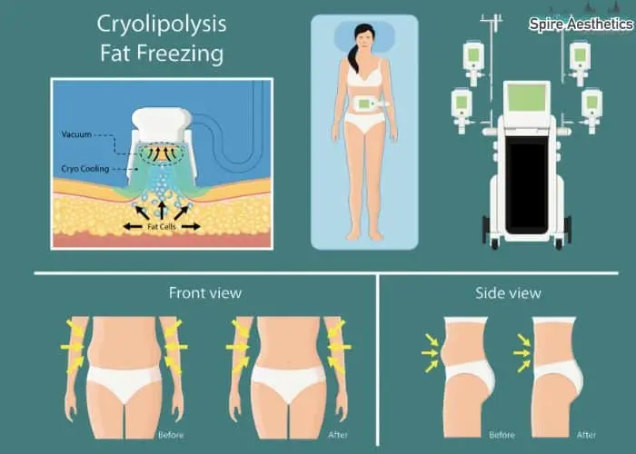 Fat freezing treatment Newcastle under Lyme benefits for competitions to remove stubborn fat deposits.