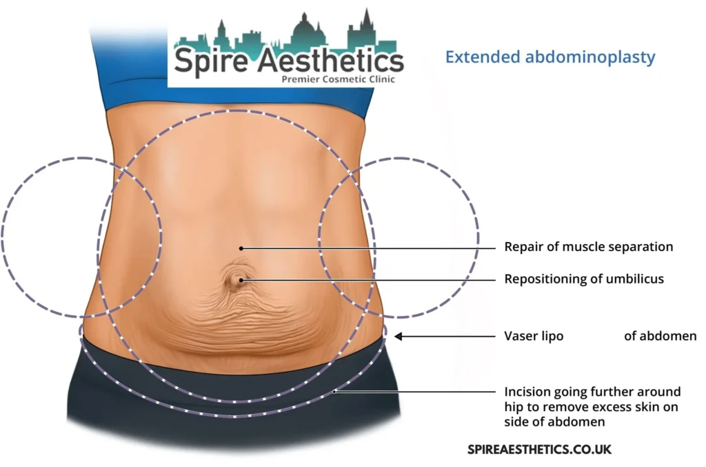 Understanding Loose Skin After Gastric Band Newcastle under Lyme Surgery and HIFU Treatment