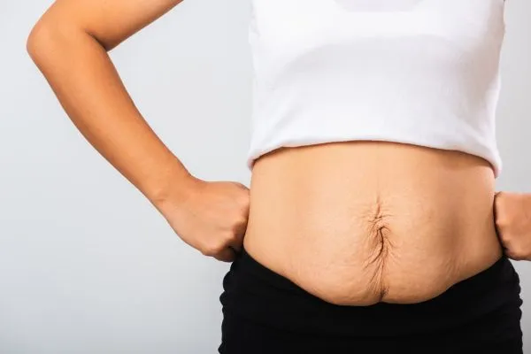 Image of a woman's stomach after weight loss with sagging skin following a gastric band Newcastle under Lyme