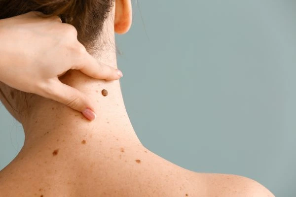skin blemish removal Newcastle under Lyme treatment