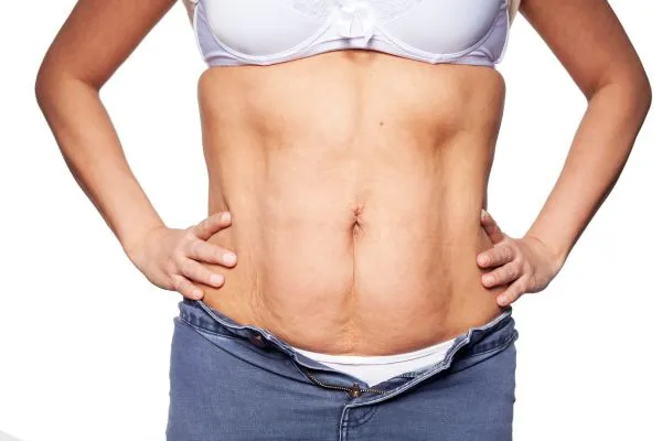 sagging skin on woman's stomach after weight loss injections Newcastle under Lyme