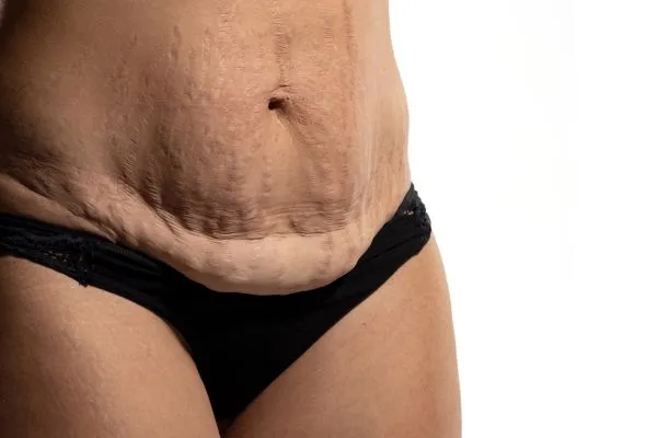 Image of womans stomach after weight loss injections Newcastle under Lyme showing saggy skin