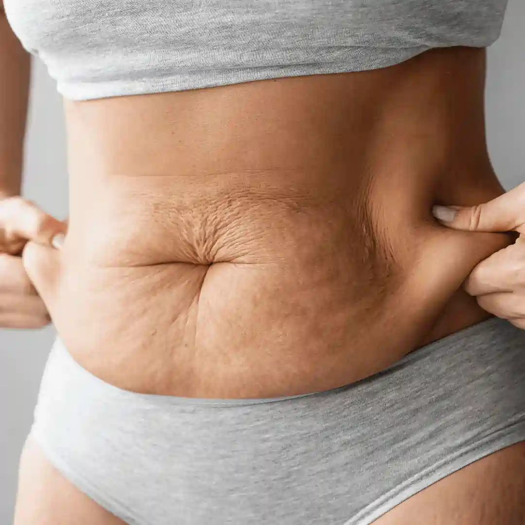 Is It Normal to Have Loose Skin After Pregnancy Newcastle under Lyme?