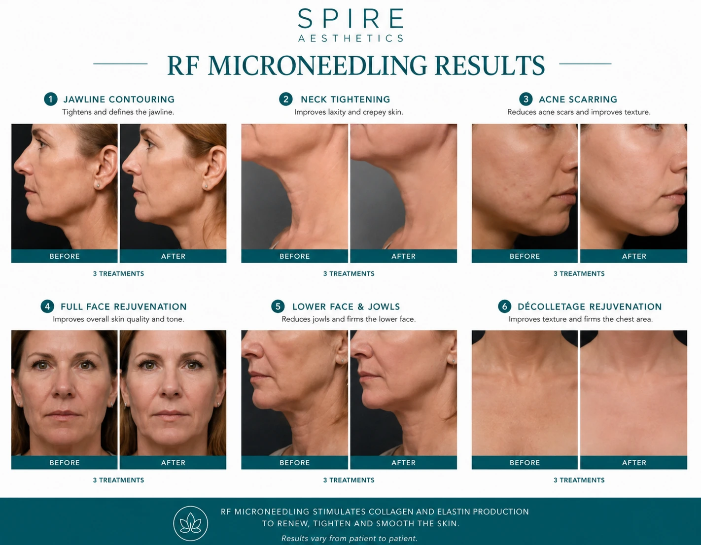 RF Microneedling Skin tightening Newcastle under Lyme results