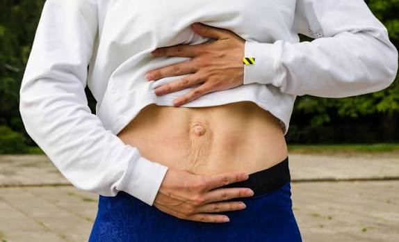 When Could Diastasis Recti Be the Missing Piece of the Puzzle Newcastle under Lyme?