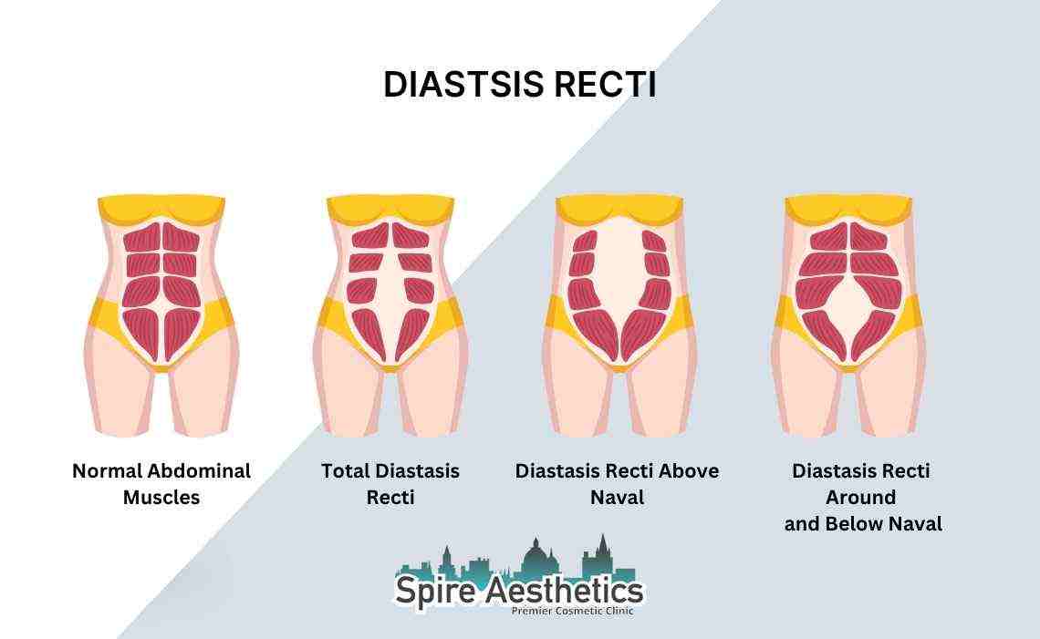 Is Non-Surgical Diastasis Recti Treatment Right for You? Common Concerns Answered Newcastle under Lyme